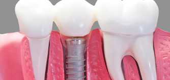 Dental Implants 